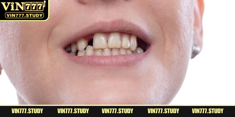 Gãy răng báo mộng những bất an trong tâm hồn